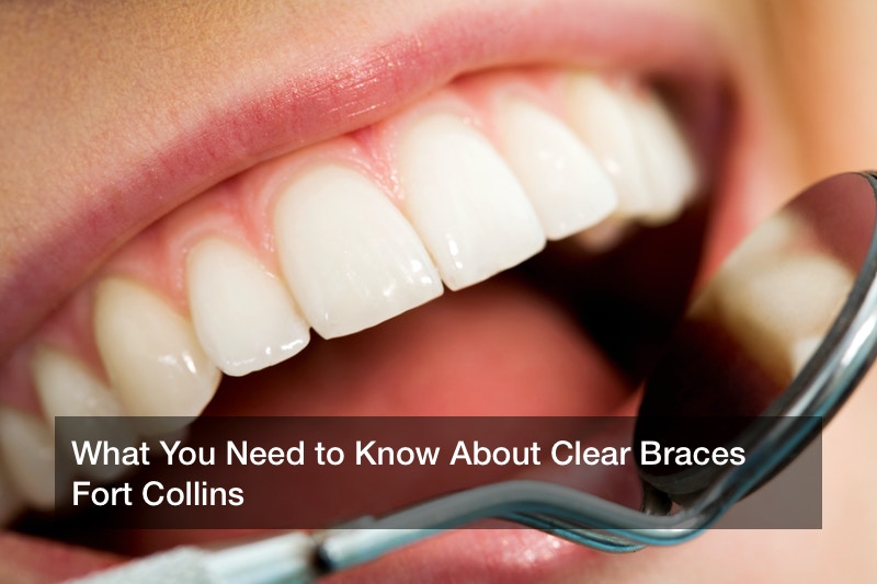 What You Need to Know About Clear Braces in Fort Collins